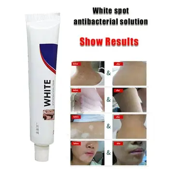 Kinų Medicinos Balta Dėmė Ligos Kremas Pigmento Melanino Skatinti Vitiligo, Odos Gydymo Leukoplakia Ligos Balta Dėmė I3X7