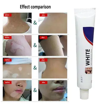 Kinų Medicinos Balta Dėmė Ligos Kremas Pigmento Melanino Skatinti Vitiligo, Odos Gydymo Leukoplakia Ligos Balta Dėmė I3X7